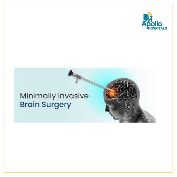Minimally Invasive Brain Tumor Surgery: A less invasive approach to treating brain tumors