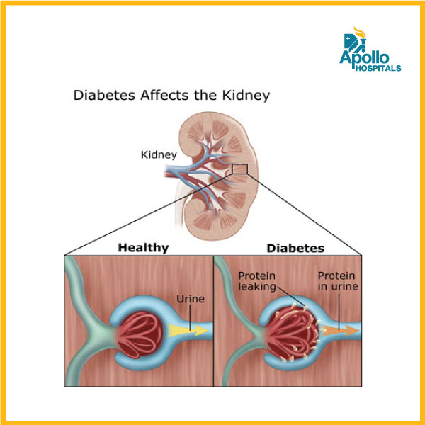Can diabetes affect my kidney health?