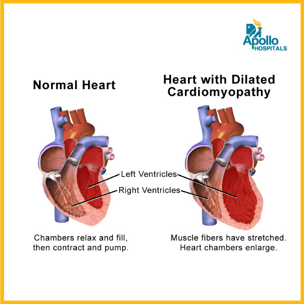 Heart transplant in cardiomyopathies