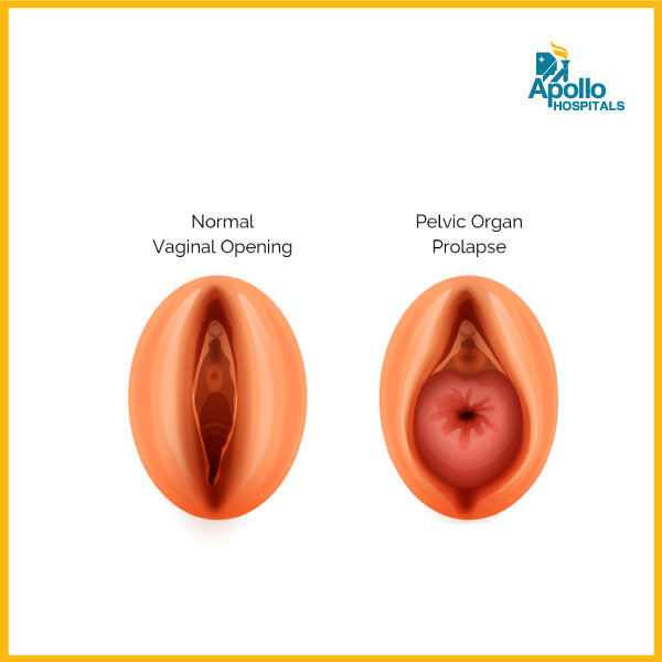 What is pelvic organ prolapse (POP)?