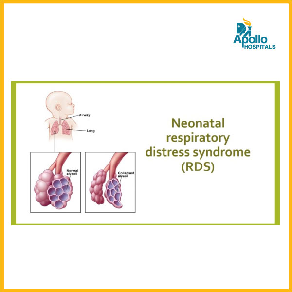 What is Neonatal Respiratory distress syndrome (NRDS) of Newborn?
