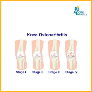 Stages of knee arthritis - Apollo Hospital - Best Hospital in Mumbai