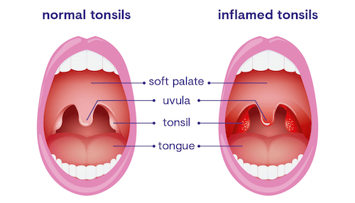 All you need to know about tonsilitis