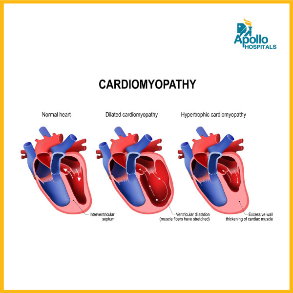 Important tips to lead a normal healthy life with cardiomyopathy