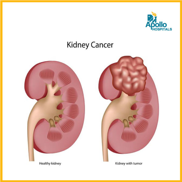 7 early warning signs of kidney cancer - Apollo Hospital - Best ...
