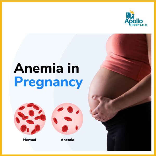 How can I treat anemia in pregnancy naturally?