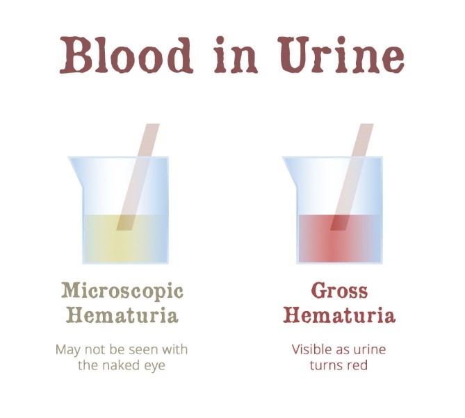 What causes blood in urine?